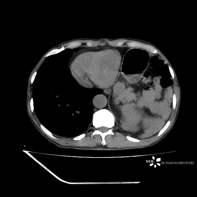 食管裂孔疝CT扫描图片素材