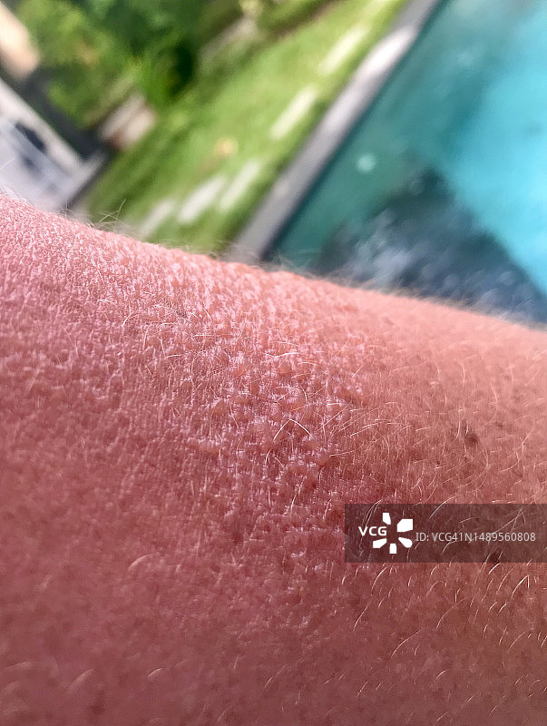 晒伤的肩膀，发红的晒伤皮肤图片素材