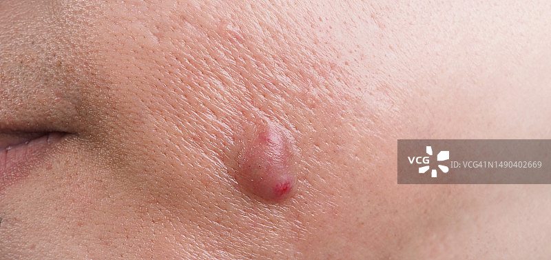 曼谷面部囊肿性痤疮肿胀图片素材