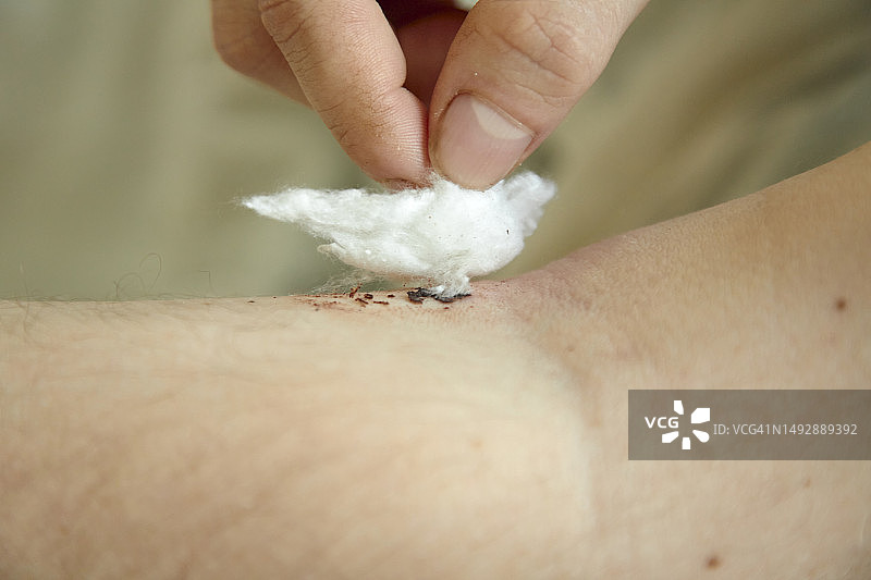 插入静脉导管后的手图片素材