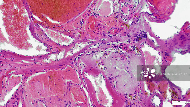 腺样囊性癌显微镜图：一种罕见的癌症，存在于许多不同的身体部位图片素材