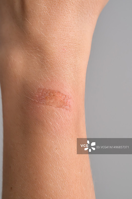 女人手上的烧伤图片素材