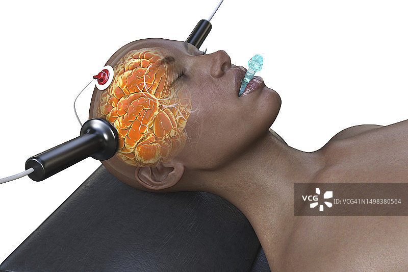 电休克疗法，插图图片素材