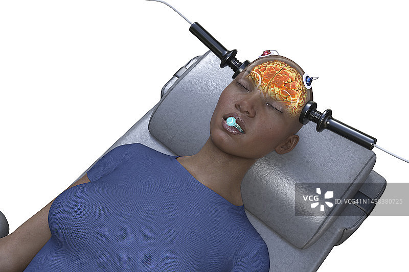 电休克疗法，插图图片素材