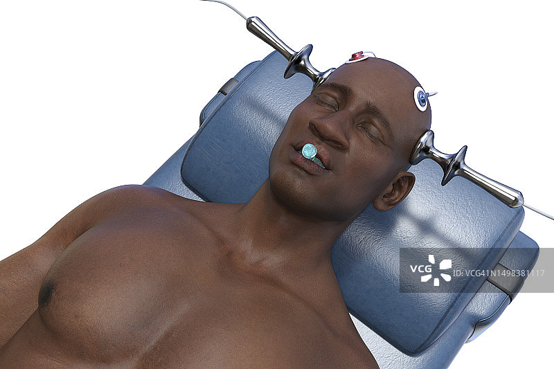 电休克疗法，插图图片素材