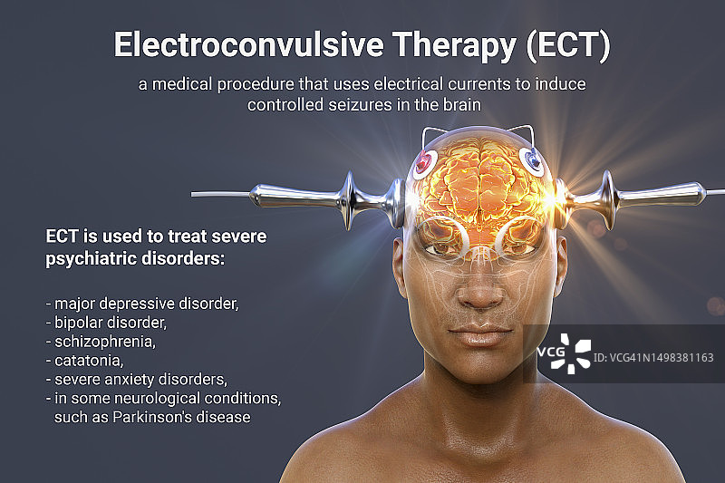 电休克疗法，插图图片素材