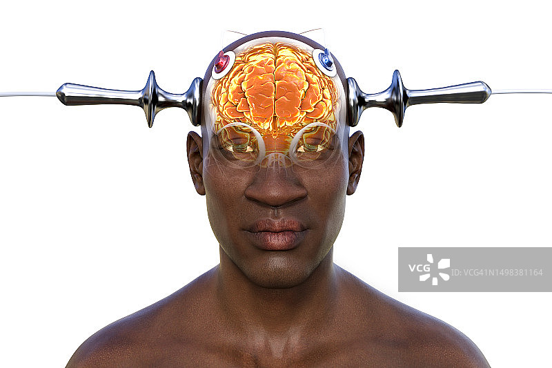 电休克疗法，插图图片素材