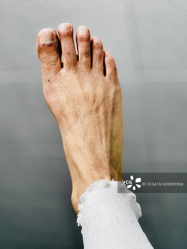 成年男性受伤瘀伤的脚趾/脚部特写图片素材