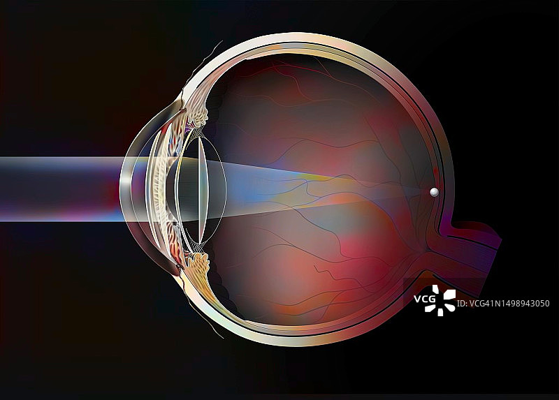 眼内植入体图片素材