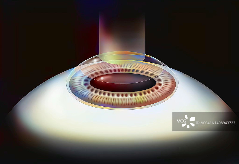 眼科手术图图片素材