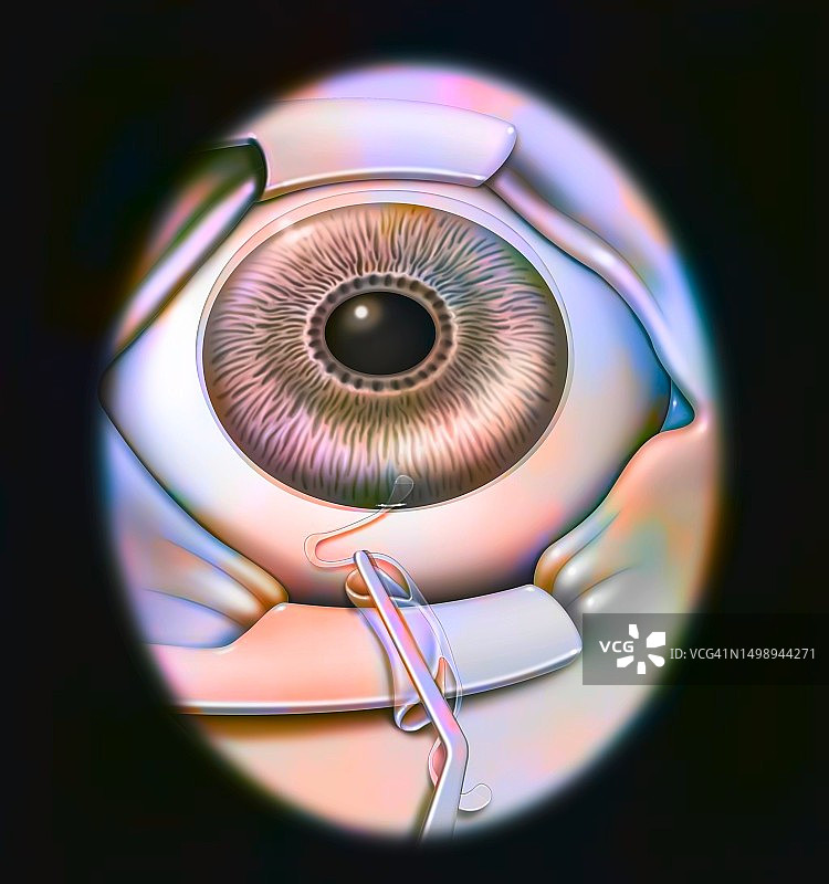 眼内植入体图片素材