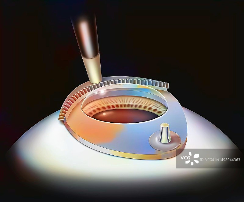 激光原位角膜磨镶术图片素材