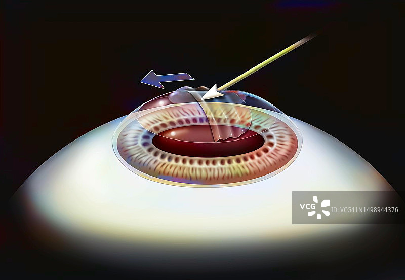 激光原位角膜磨镶术图片素材