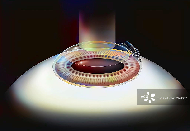 激光原位角膜磨镶术图片素材