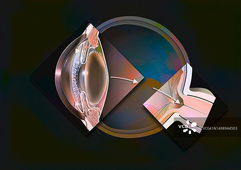 青光眼图图片素材