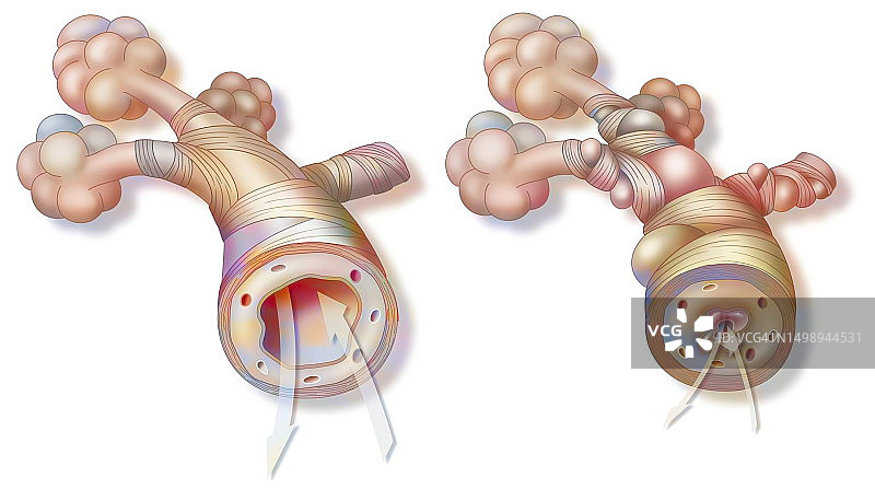 哮喘示意图图片素材