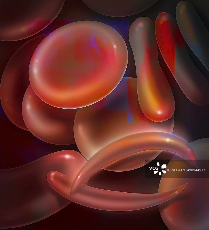 镰状细胞病图图片素材