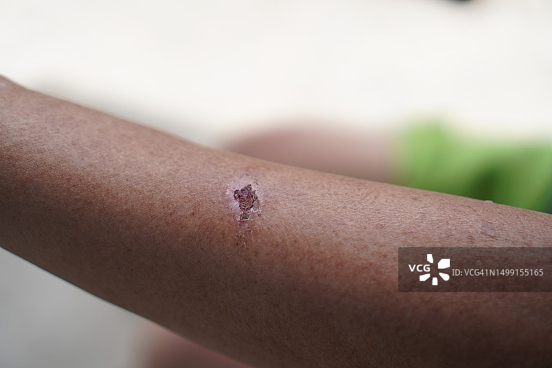 手臂上的擦伤、伤口正在结痂图片素材