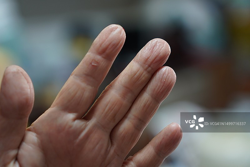 食指伤口图片素材