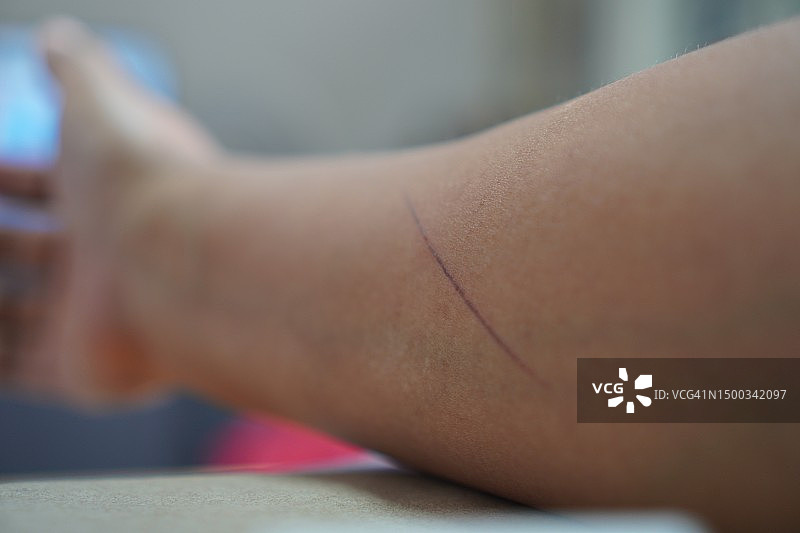 手臂上的擦伤、伤口正在结痂图片素材