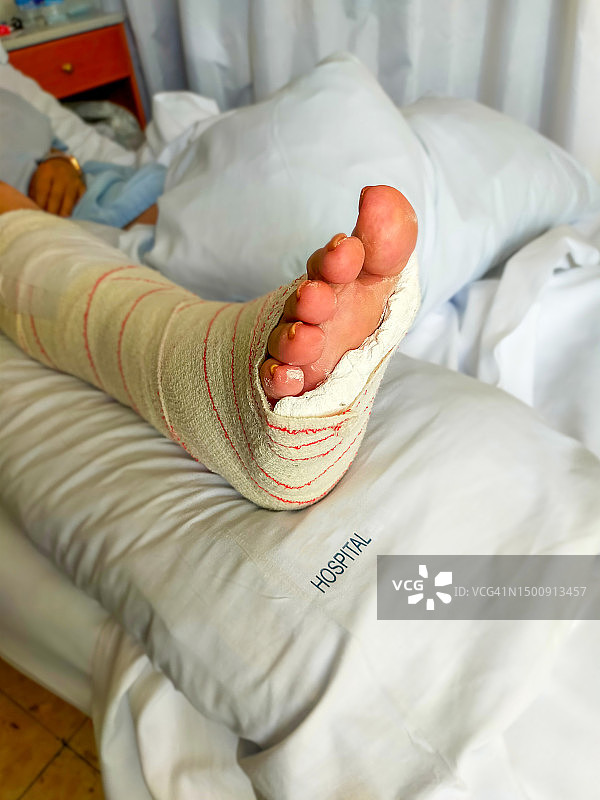 脚部骨折图片素材