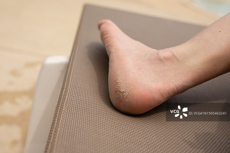 足跟干裂治疗图片素材