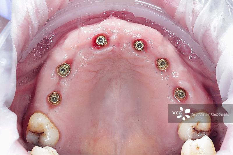 特写：人颌骨中植入的螺旋式牙科植入物图片素材