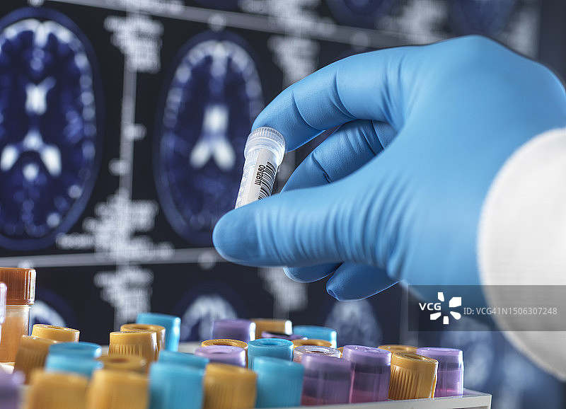 英国海威科姆阿尔茨海默病和痴呆症研究：科学家在临床试验中手持血液样本，屏幕上显示MRI图片素材