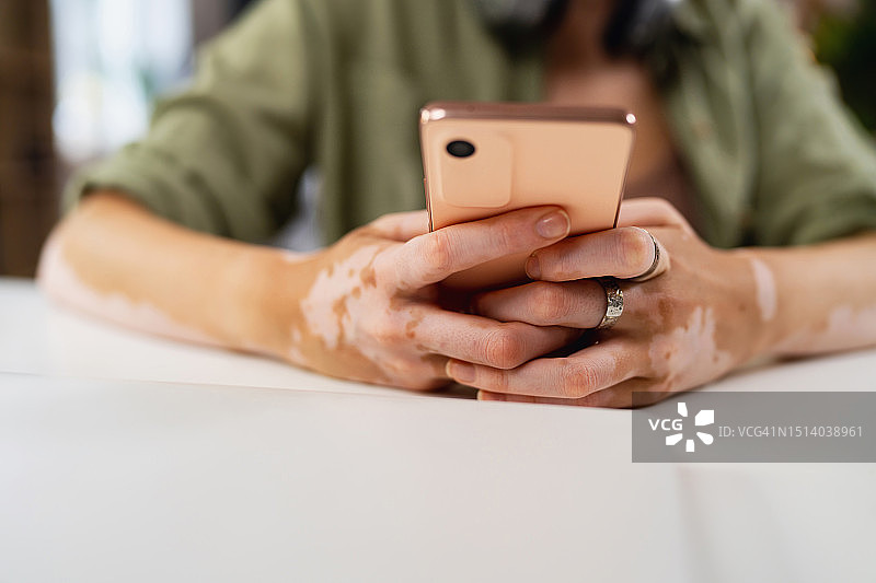 手部患有白癜风的女人使用手机特写图片素材