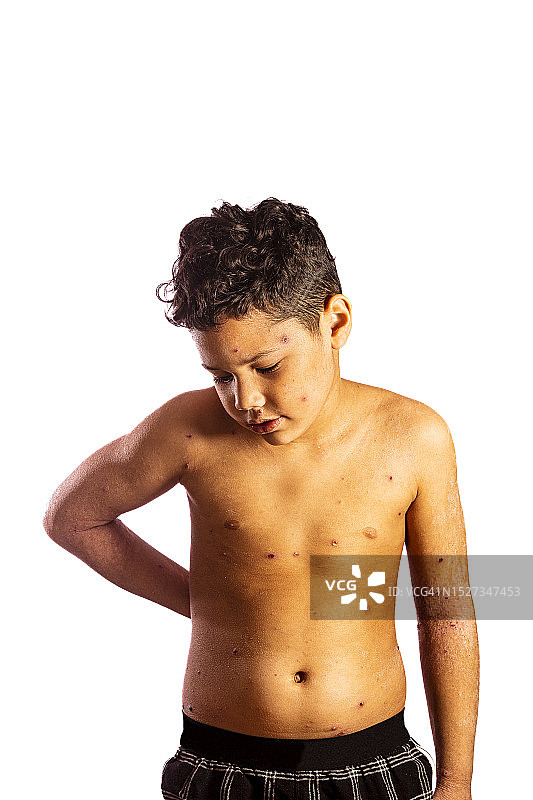 患有水痘的男孩图片素材