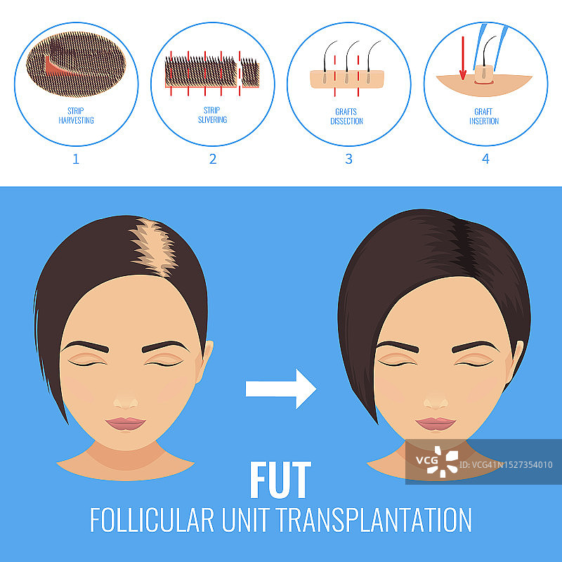 毛发移植插图图片素材