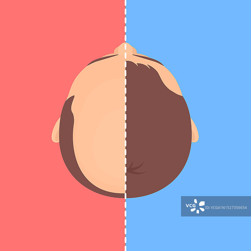 头发移植效果对比图图片素材