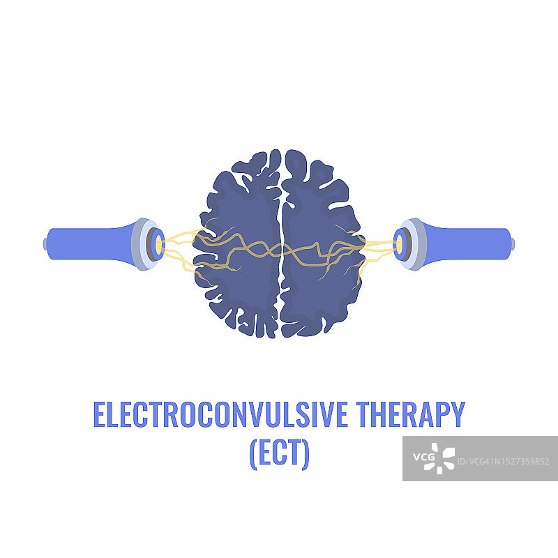 电休克疗法，插图图片素材