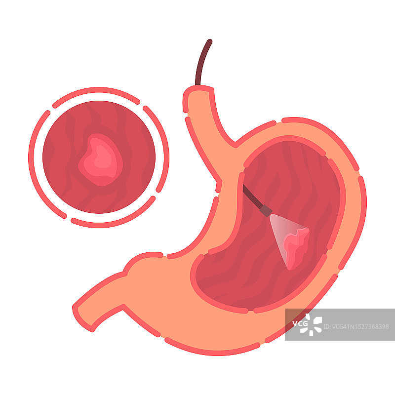 胃镜检查插画图片素材