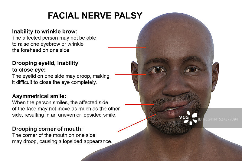 面瘫图示图片素材
