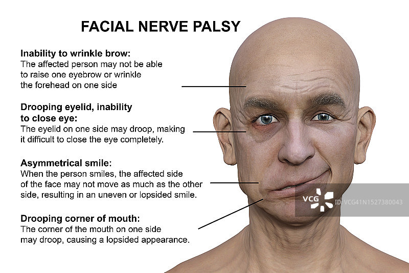 面瘫图示图片素材