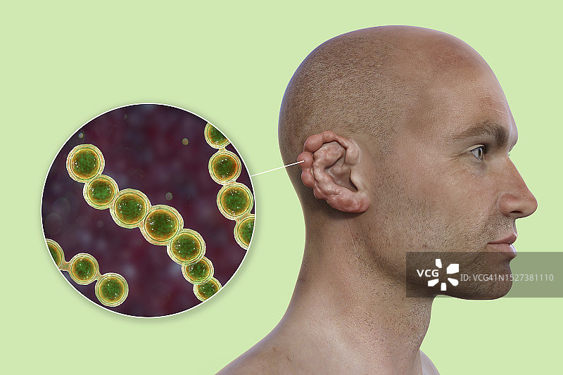 洛博菌病真菌感染，图示图片素材