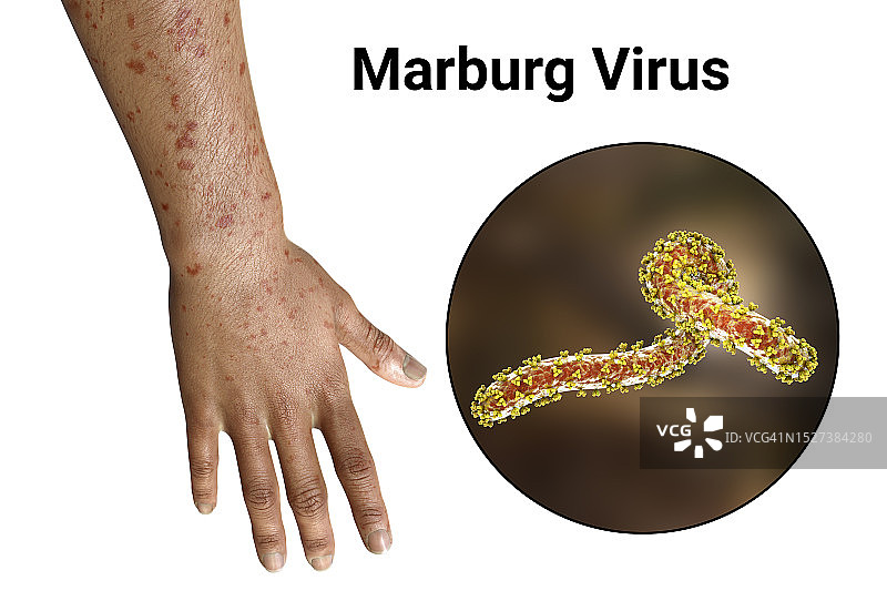 马尔堡出血热皮疹插图图片素材