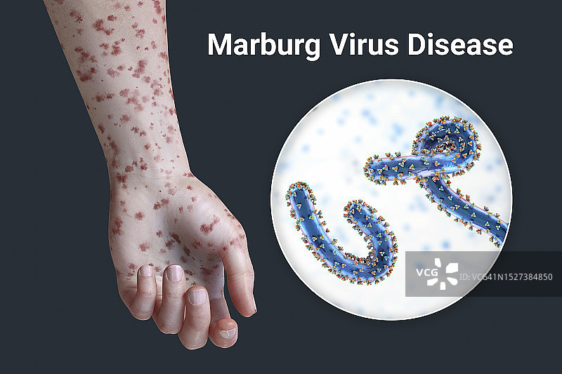 马尔堡出血热皮疹插图图片素材
