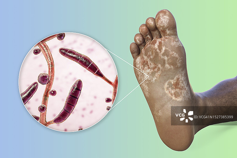 脚气病插图图片素材