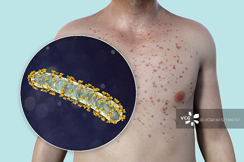 马尔堡出血热皮疹插图图片素材