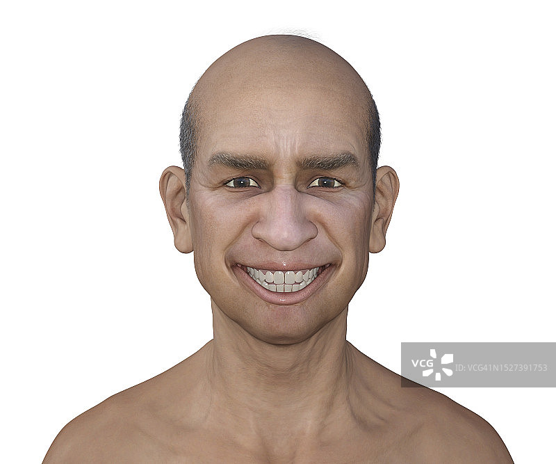 破伤风中的牙关紧闭插图图片素材