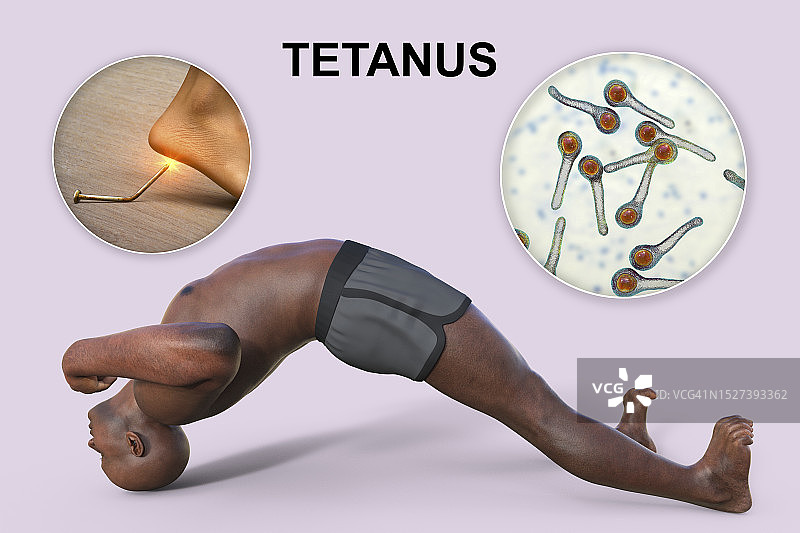 破伤风，图示图片素材