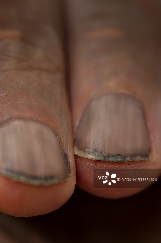 脏污的手指甲图片素材