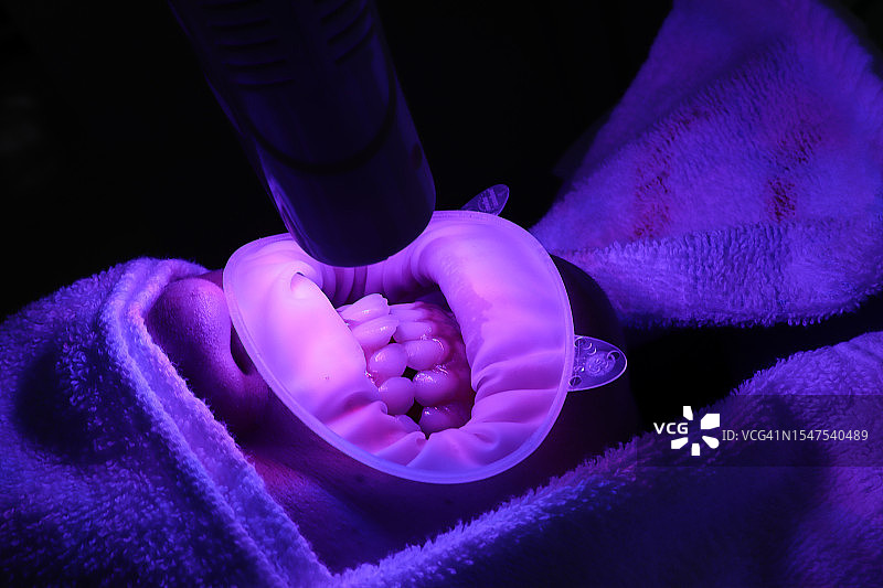 牙科诊所使用紫外线固化患者牙齿图片素材