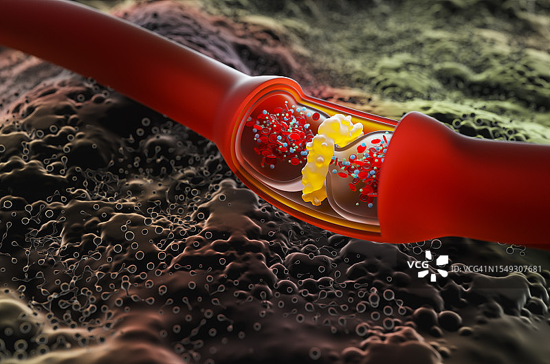 静脉曲张概念特写，带有血栓科学模型的开放静脉图片素材