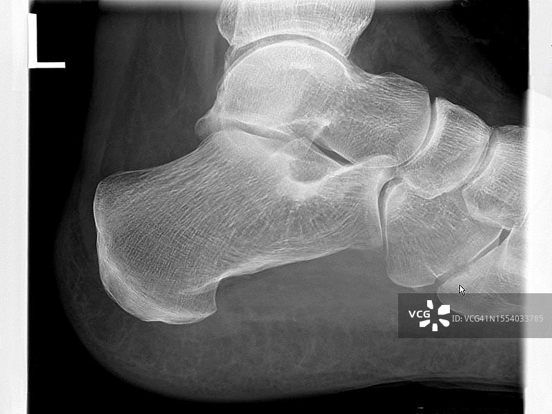 脚跟骨X光片图片素材