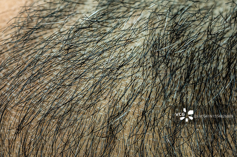 男人头上稀疏头发的全景照片图片素材