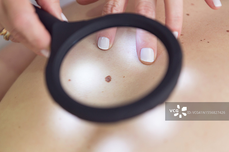 女医生用放大镜检查病人的痣图片素材