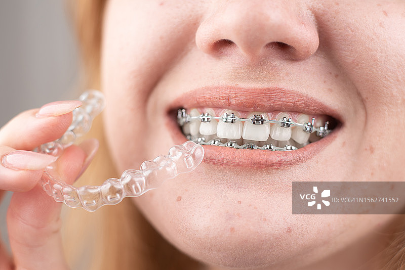 牙科护理：微笑的女孩牙齿上戴着牙套，手持矫正器，展示它们之间的区别图片素材